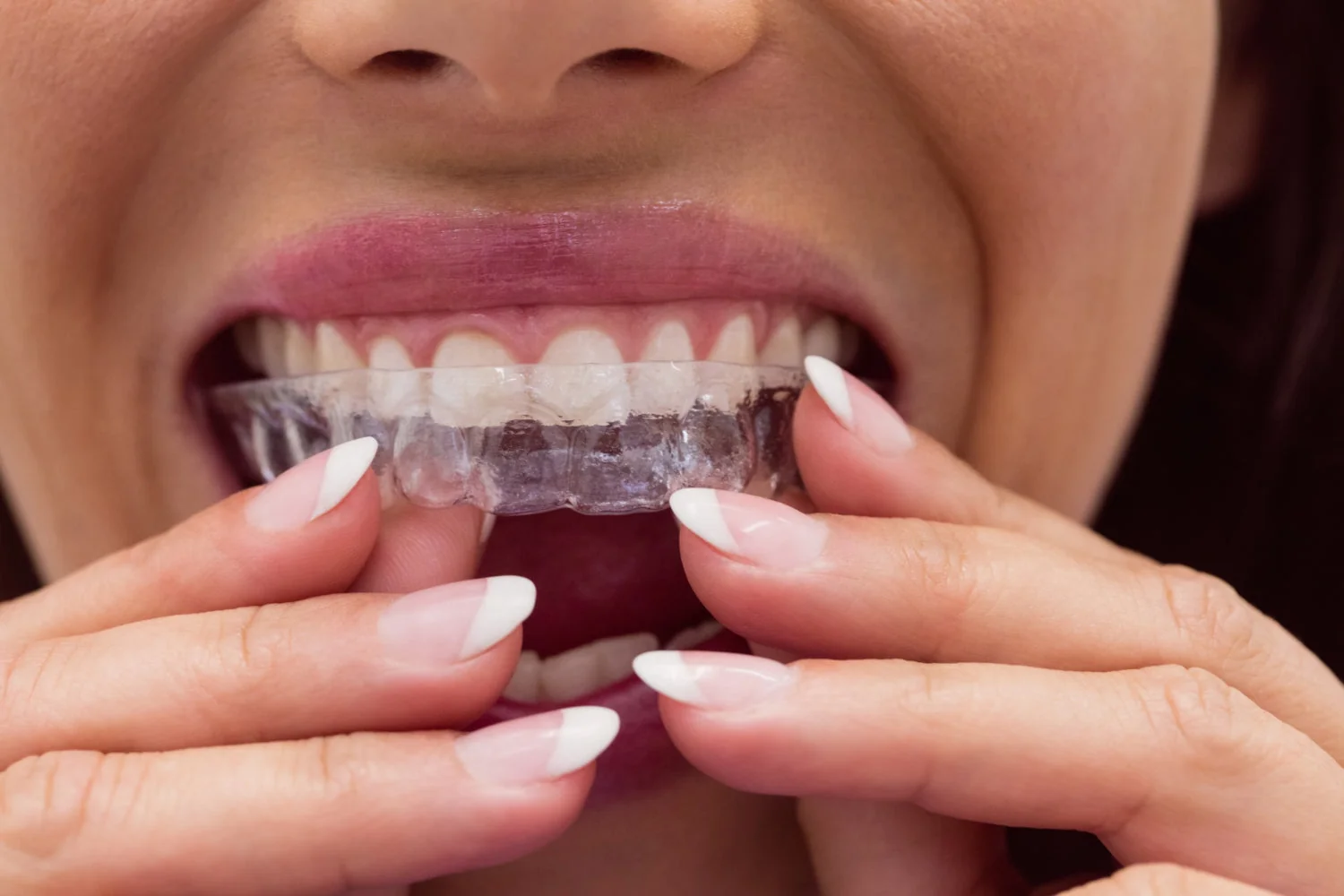 Lingualtechnik vs. Aligner